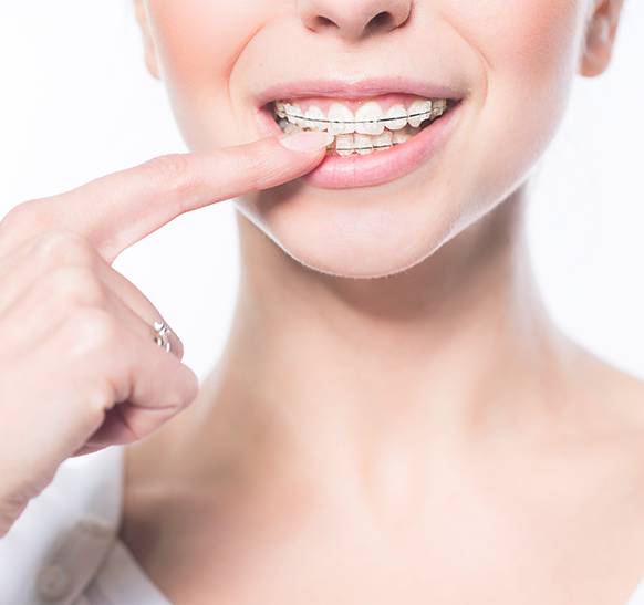 ceramic braces