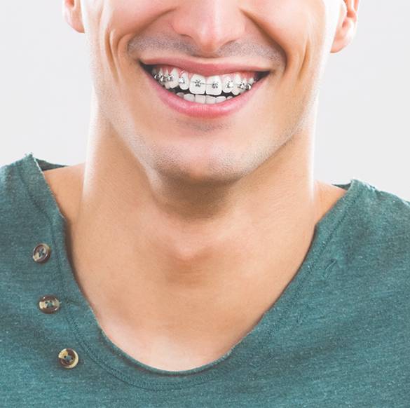 metal braces